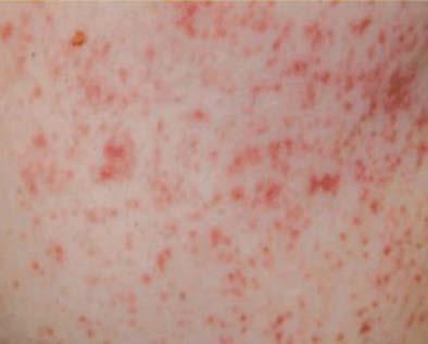 Skin Papular dermatitis Often caused by mange.