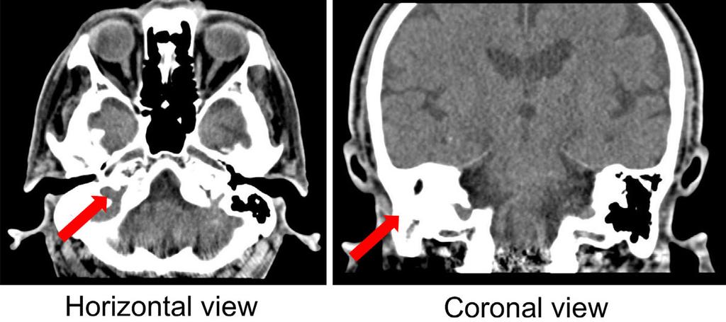 Figure 1. Head CT performed on admission shows poor pneumatization of the right mastoid cells and a shadow in the soft tissue from the right epitympanum to the middle ear. sponsiveness to questions.