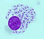 Toxoplasma gondii tachyzoite Disease: toxoplasmosis Congenital
