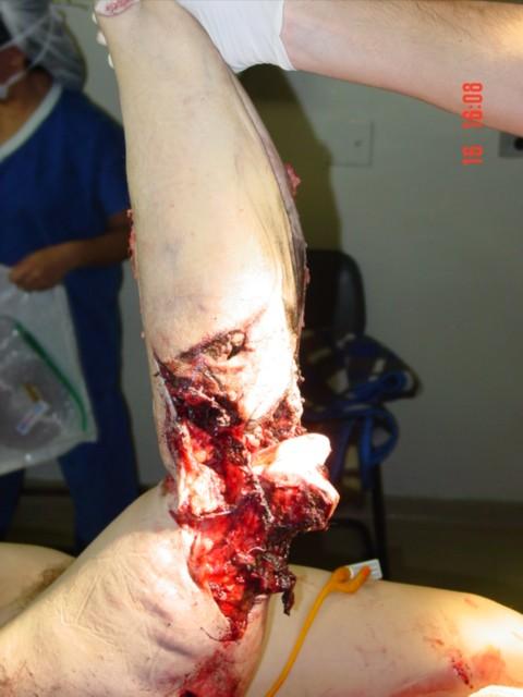 Tourniquet Removal REMEMBER: If unable to control bleeding except with a