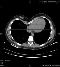 Pectus Excavatum accounts for approximately 90% of congenital chest wall deformities. Congenital frequently noted at birth becoming more pronounced in early adolescence.