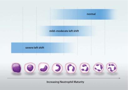 Hematology Left shift particular population is shifted towards more immature precursors