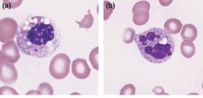 Right Shift - Neutrophil count will be higher than normal range (predominant cell