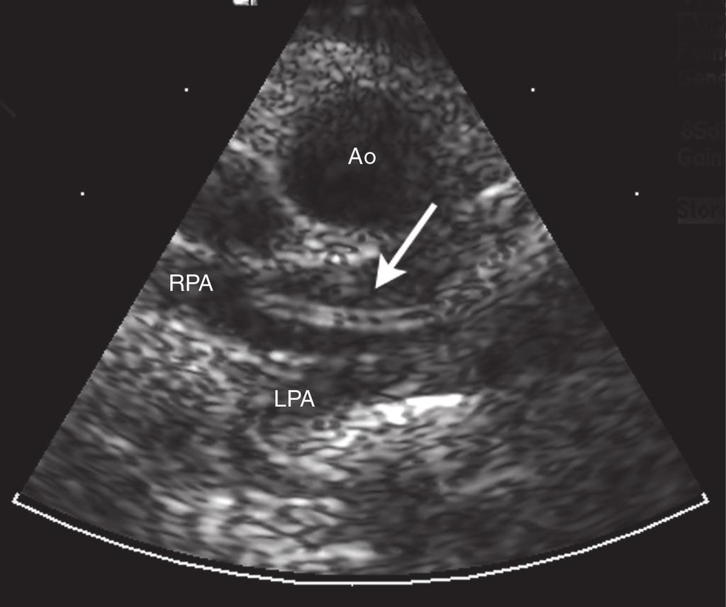 FIGURE 3. Short-axis, 2-dimensional echocardiogram at the heart base, revealing a single adult heartworm identified as 2 echo-dense parallel lines in the right pulmonary artery (arrow). Courtesy Dr.