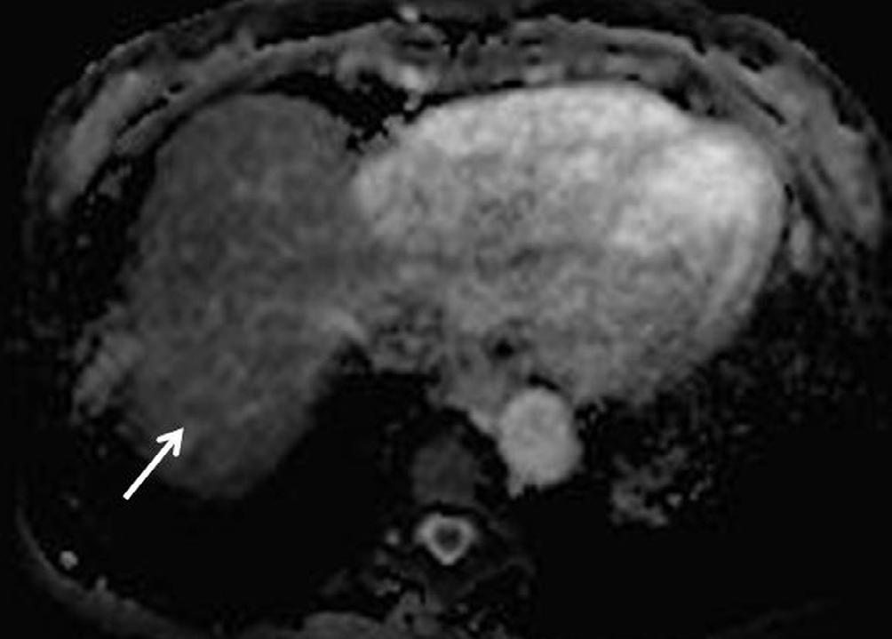 (a) T1-weighted axial MR image shows a tiny, faintly hypointense
