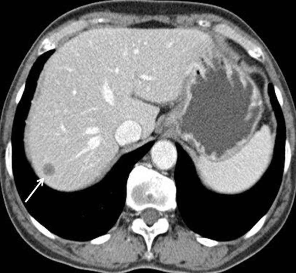 https://doi.org/10.13104/imri.2018.22.2.113 Fig. 6. Follow-up CT (2.5 years later).