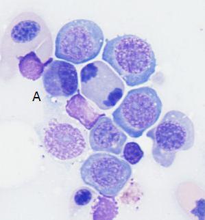 basophilic cytoplasm). Macrophages were rare, and cytophagia was infrequently noted.