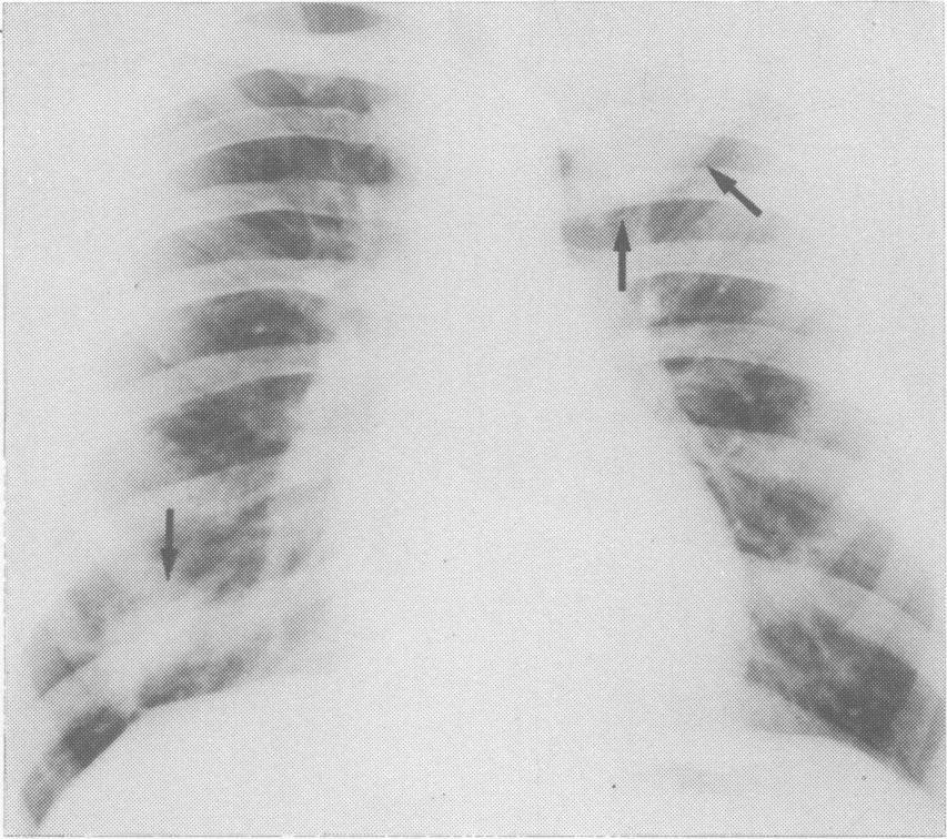 I.. Figure 2 PA chest radiograph: large apical left upper lobe hydatid cyst and small right lower lobe hydatid cyst (arrows).
