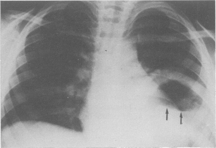 Multiple pulmonary cysts have been reported in 30-40% of patients in different series. Bilateral cysts were present in 20% of patients in the series reported by Balikian & Mudarris (1974).