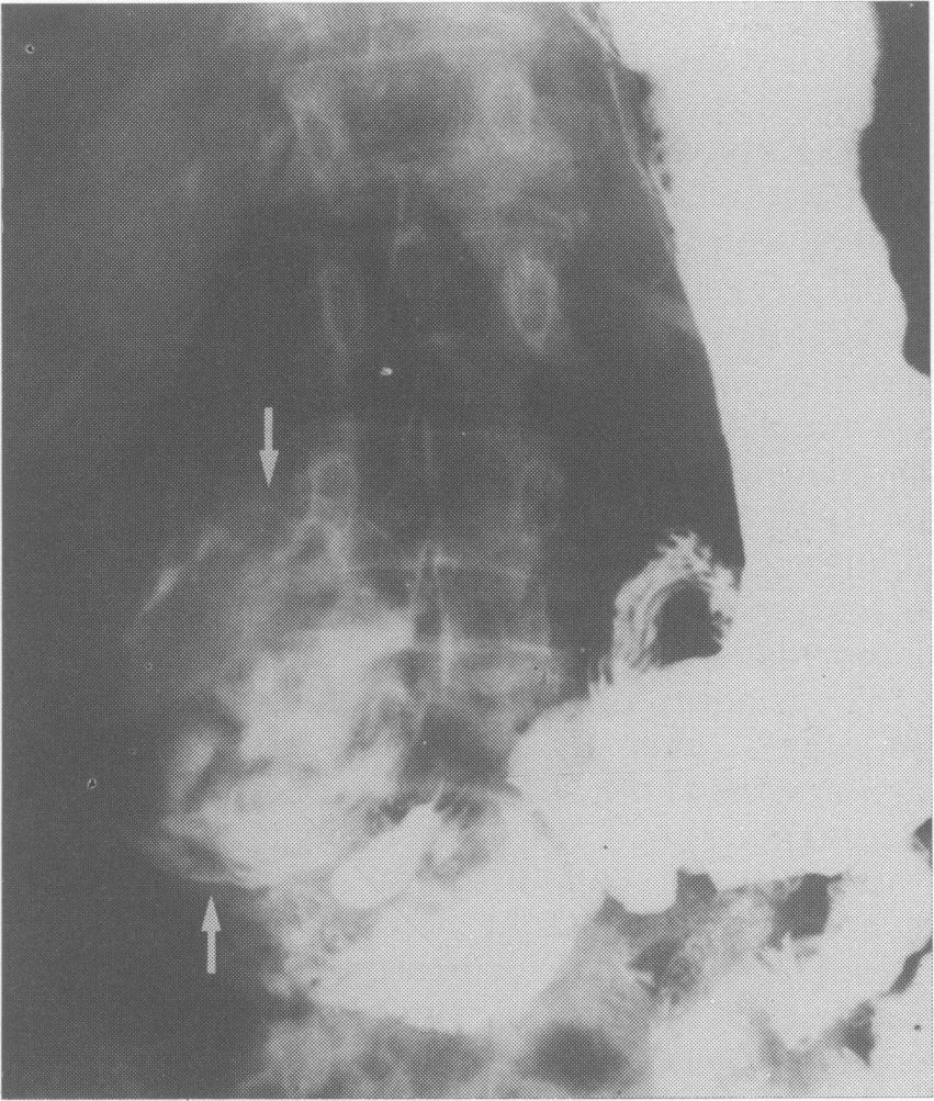 Radiological calcification in thoracic hydatid cysts is extremely rare and was not present in any of our cases, or in the series of Balikian & Mudarris (1974).