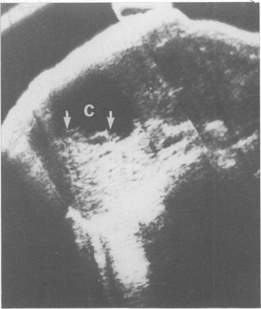 The ultrasonic features ofhepatic hydatid cysts were reviewed by Beggs (1983). Most hepatic hydatid cysts appeared as well-defined thin walled anechoic areas with distal enhancement.