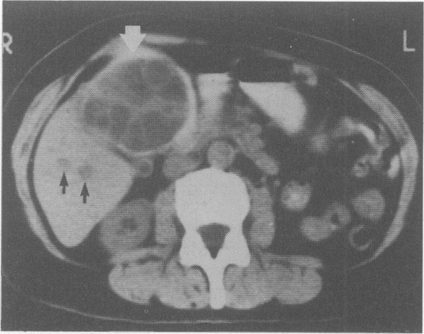 'floating membrane', as seen in Figure 6. Ismail et al. (1980) reported the CT appearances of 121 hepatic hydatid cysts.
