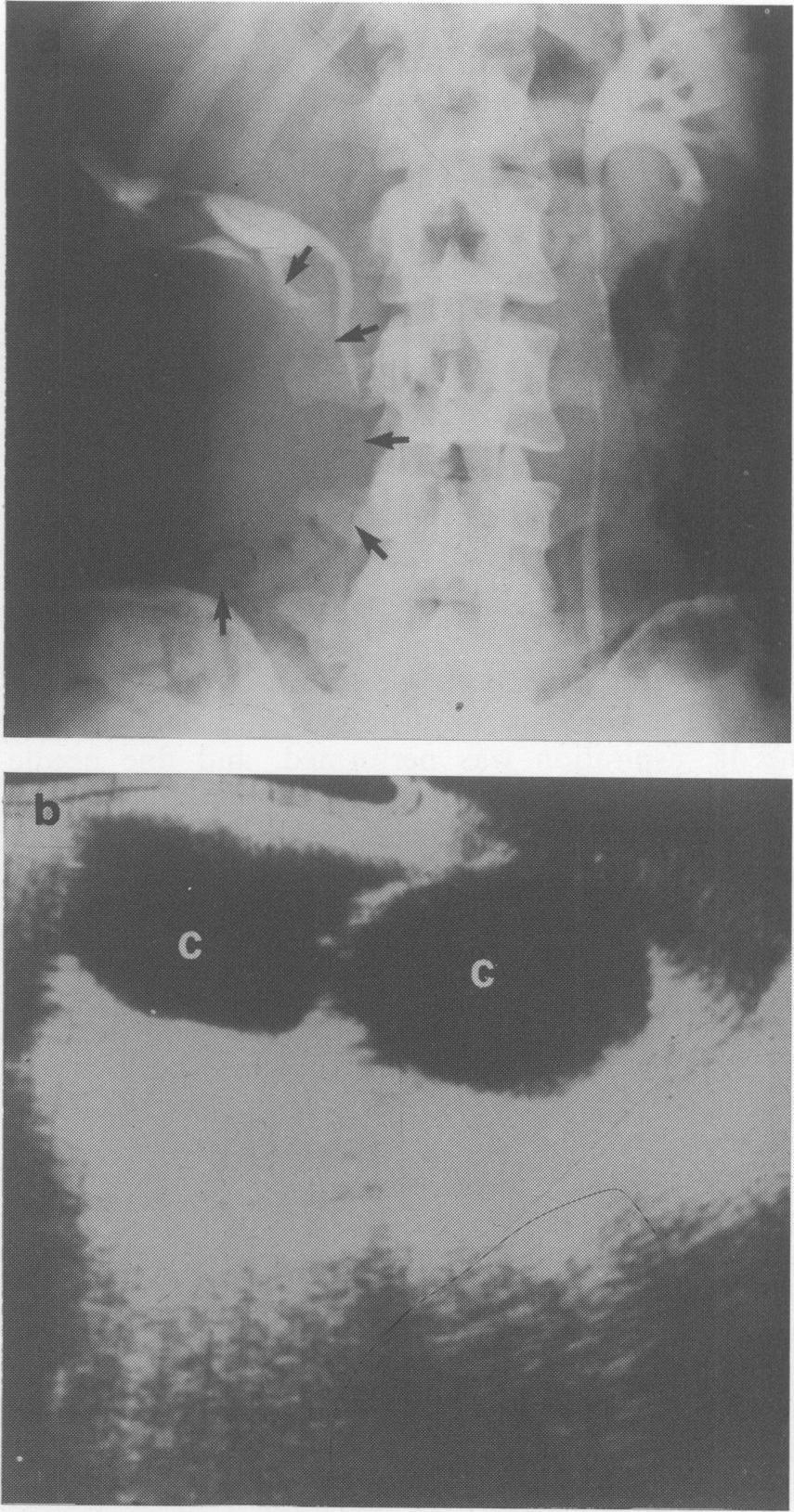 Abdominal radiography may show a soft tissue mass in the loin if the kidney is enlarged by a hydatid cyst.