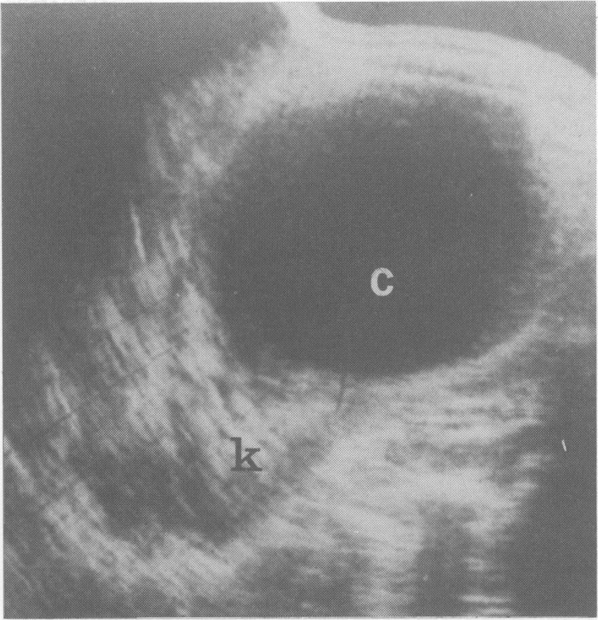 172 R. CLEMENTS & I.H. GRAVELLE ultrasonic scan of a hydatid cyst of the upper pole of the left kidney is illustrated in Figure 10.