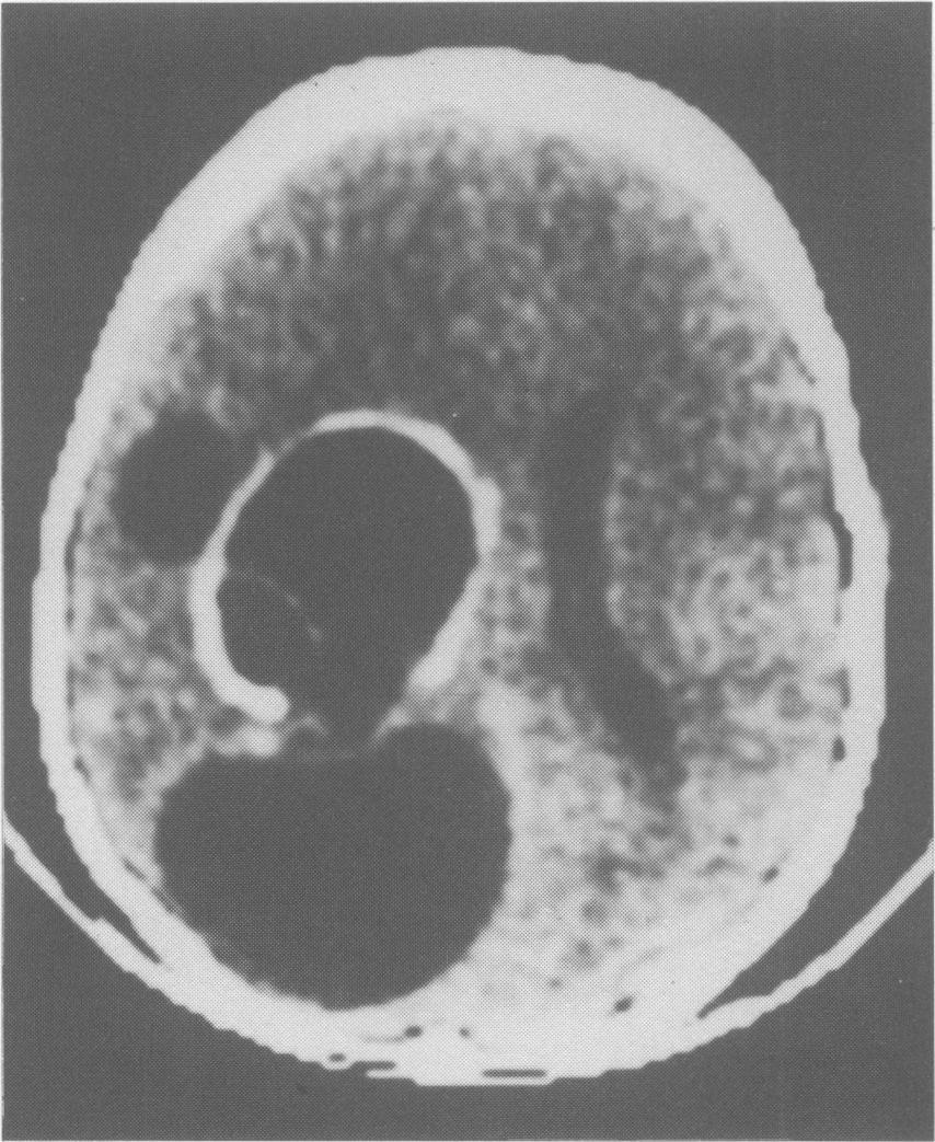 Cyst calcification may been on plain skull radiography or CT (Figure 11). Bone hydatid cysts These are rare, and occur in about 2% of patients with hydatid disease.