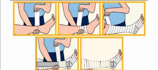 FIRST AID TREAMENT Pressure immobilization method: Crape bandage or long strip of cloth is wrapped around the entire limb