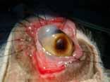 amorphous dense substance continuous with epithelial basement membrane and overlaying corneal ulceration.