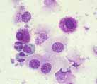eosinophils with red granule, degranulated mast cells.