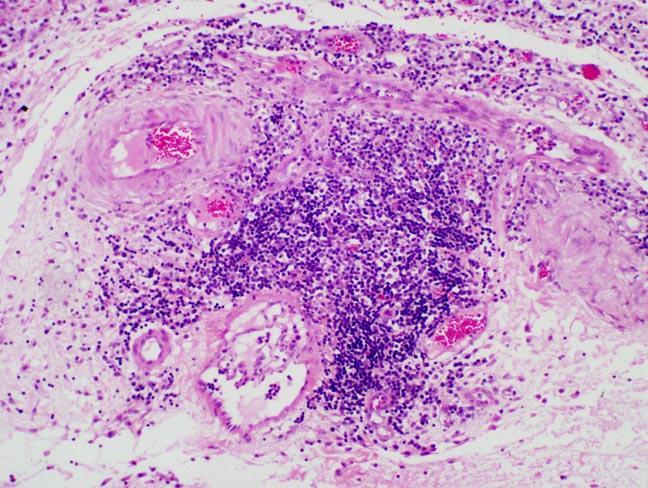 Pyogranulomatous inflammation FIPV infected monocytes