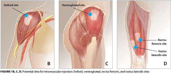 Sites of IM injections : 1. Ventrogluteal site: site is in the gluteus medius muscle, which lies over the gluteus minimus. 2.