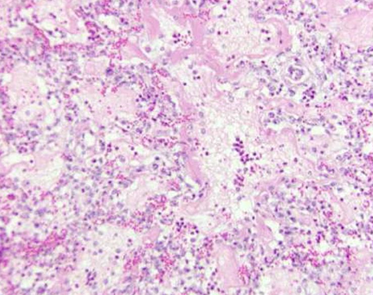 Histopathology In 26 confirmed AIP cases 13 had lesions of AIP in cranial lungs 26 had lesions of AIP in caudal lungs 9 of 26