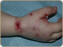 contamination of skin wounds or mucous membranes with saliva containing the virus; very rarely by