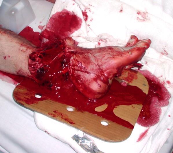 death from injury Bleeding from these wounds can be controlled by