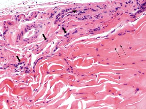 Histopathologic examination of some parts of the flexor tendons revealed dense and thick collagen bundles associated with a few non-reactive small fibroblasts.