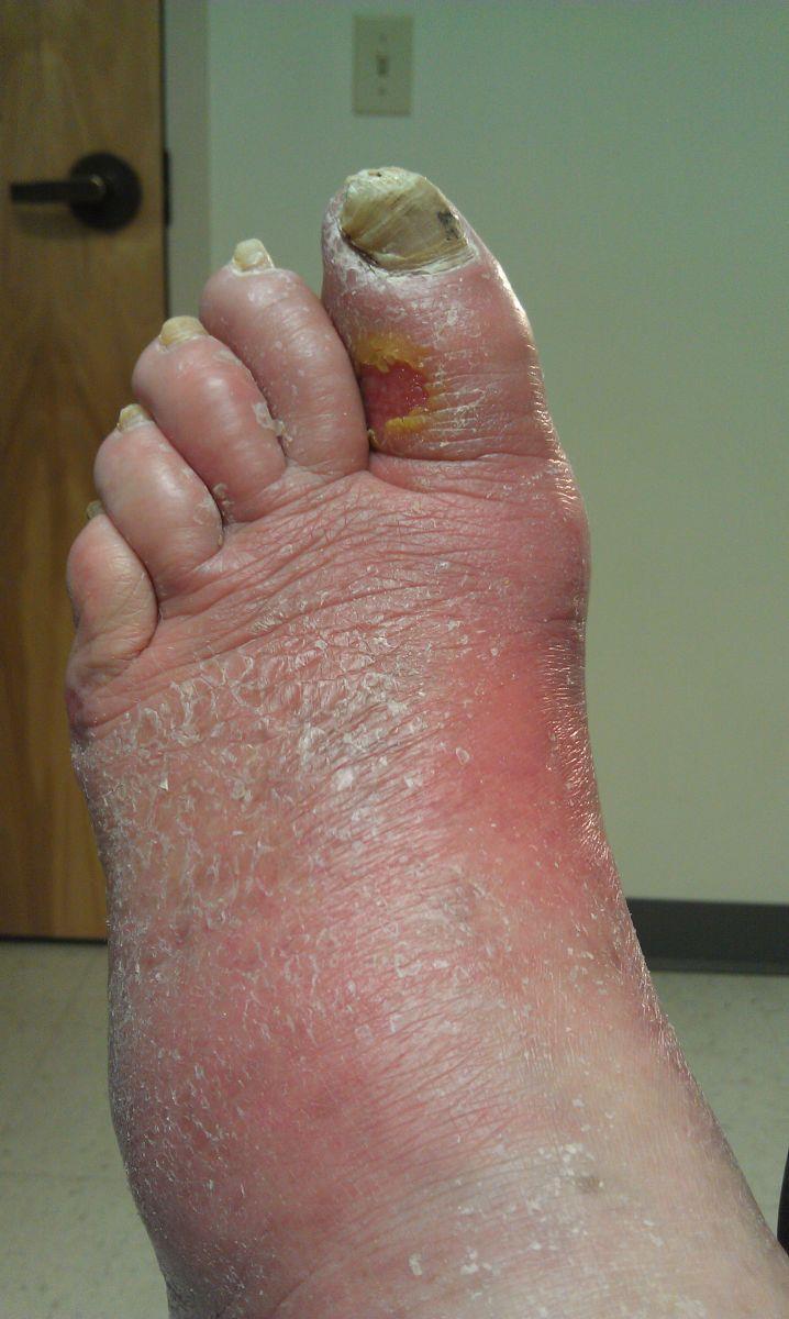 Diagnosing diabetic foot infection At least 2 of the following items: Local swelling or induration