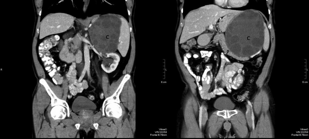 Disseminated hydatidosis with splenic involvement tient, a 79-year-old male, was diagnosed with a single 5 cm SH in concomitance with an unresectable gallbladder cancer stage IV.