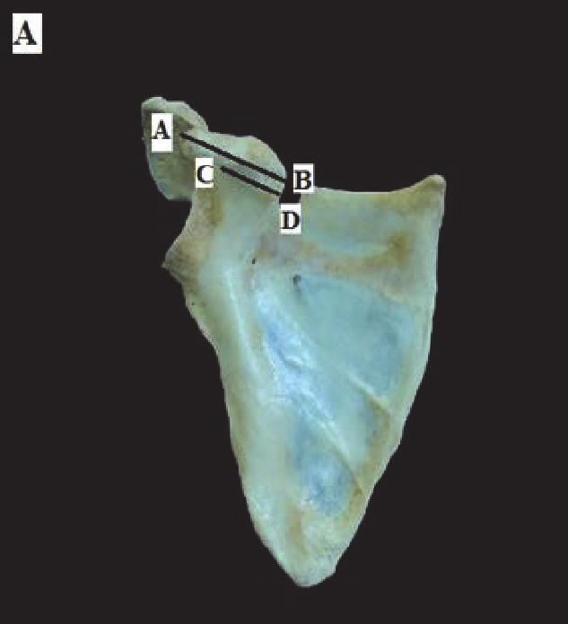 2 BioMed Research International (a) (b) (c) A C B D E H F G B D I J C A Figure 1: (a) Front view of the right scapula illustrated the measurement taken: (1) A-B line: the length of coracoid process
