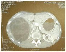 3. Horchani, A., Yassine, N., Kbaier, I., Attyaoui, F. and Zribi, A. S.: Hydatid cyst of the kidney. A report of 147 controlledcases. Eur Urol, 38: 461, 2000 4. Angulo, J. C., Sanchez-Chapado, M.