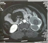 Fig. (c): CT reveals large hydatid cyst