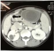 (d): Hydatid cyst in liver and right kidney.