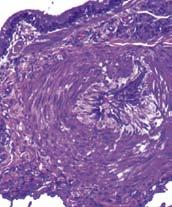 The most notable microscopic lesion is occlusive medial hypertrophy of the small pulmonary arterioles, but other changes are also noted in the bronchi, bronchioles, alveoli, and pulmonary arteries.