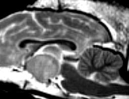 MRI / CT scan Useful for