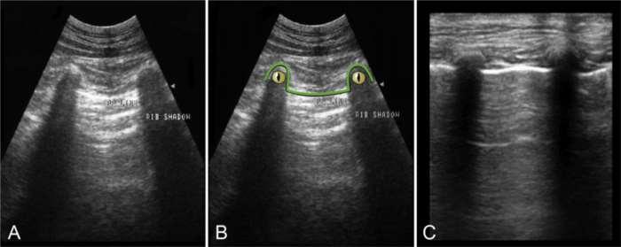 THE "GATOR SIGN" - BASIC LUNG ULTRASOUND ORIENTATION The rounded rib heads are likened to the eyes, and the pulmonary-pleural (PP line) interface to the bridge of its nose, as a partially submerged