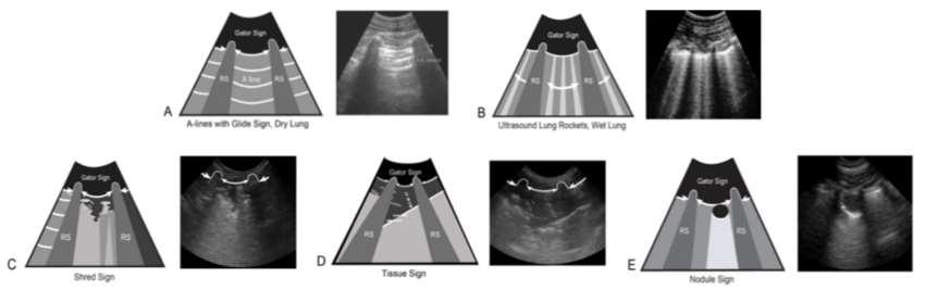Shred Sign, Tissue Sign, and Nodule Sign (plus Wedge Sign) - Advanced Lung Ultrasound These are the 3 more advanced LUS signs we have created in progressive order of increasing