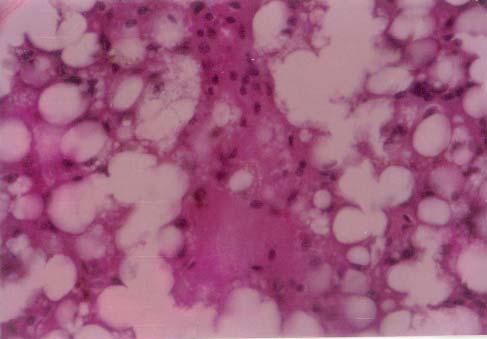 round space and granular cytoplasm of hepatic cells. H&E X 200. Figure 2.