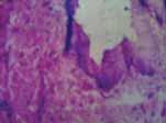 caecal graft on (H&E-150), showed epithelial lining was not clearly discernible at the