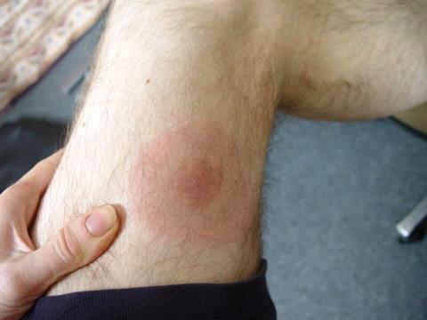 Erythema migrans (EM) the target rash Important clinical feature