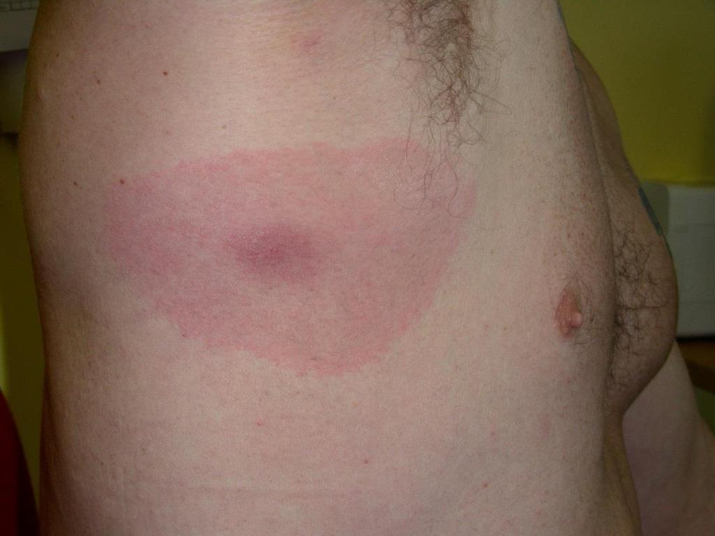 weeks The rash does not appear in over 40% of cases in Scotland The
