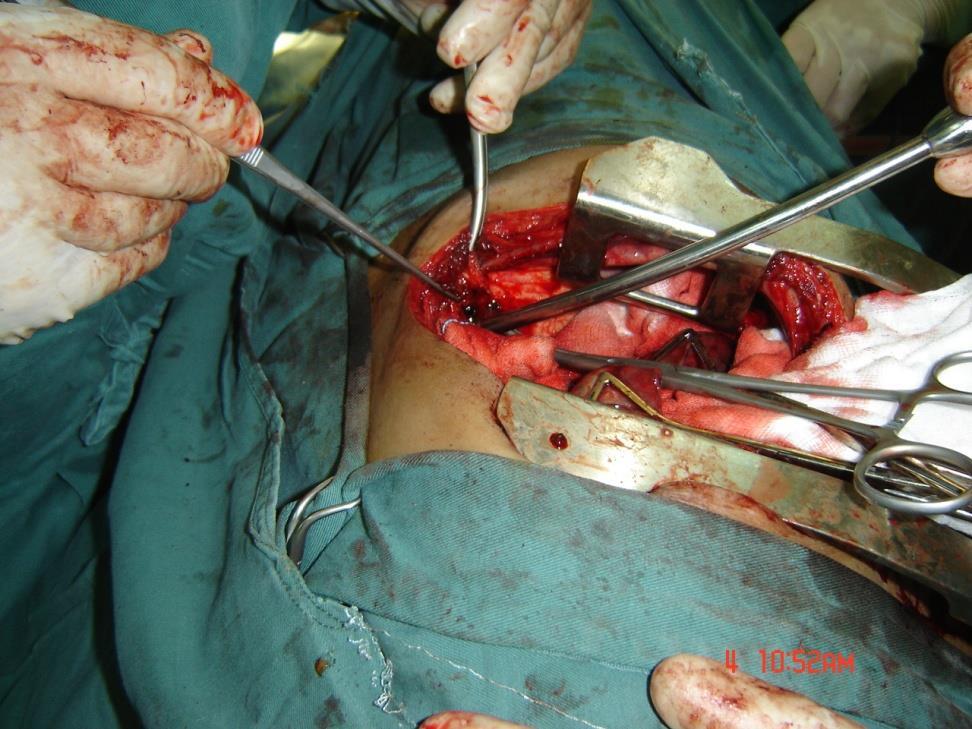 Pt prepared for operation Rt posteriolateral thoractomy Rt bronchobiliary
