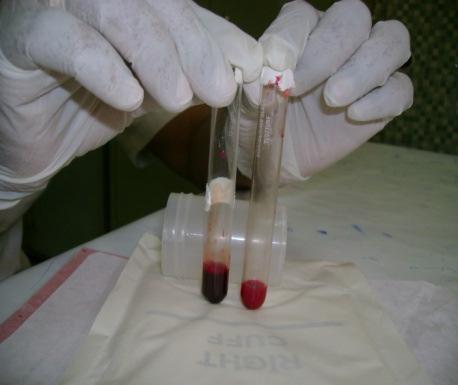 69 Figure 1. shows the results of 20-minutes whole blood clotting test for victims of snake bite With clinical swellings. Coagulable blood (Rt. Hand) and incoagulable blood (Lt.