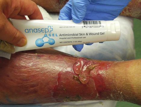 Clinical Case Study - Venous Stasis Dermatitis And Weeping Ulcers by: Martin Winkler, MD, FACS Creighton University Department of Surgery (Contributed Service), Omaha, NE University of Nebraska
