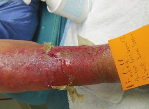 Hypochlorite gel is liberally applied to wound before Robert Jones dressing is applied at weekly clinic visits.