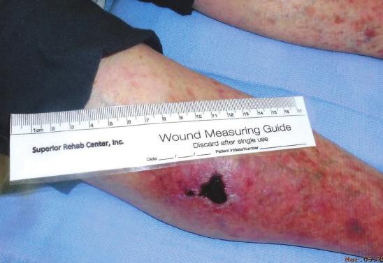 Clinical Case Study - Leg Wound by: Jean O. Galloway, PT-Superior Rehab Center Newport Beach, CA. Clinical Challenge: To heal wound on Right leg. t h e p a t i e n t : Mrs. N. is an 89 year old female who struck her right anterior lateral leg on the corner of her car door.