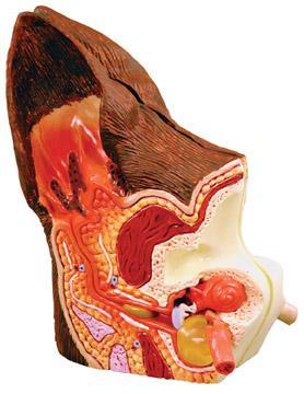 Abnormal Side illustrates inflamed inner ear structures, inflammatory