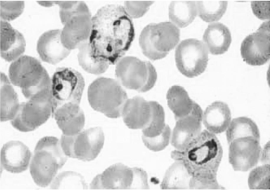 3: Growing trophozoite- Amoeboid form (b) Growing trophozoite: Amoeboid form with pseudopodia-like cytoplasmic extension Note infected red cell is larger than uninfected red cell