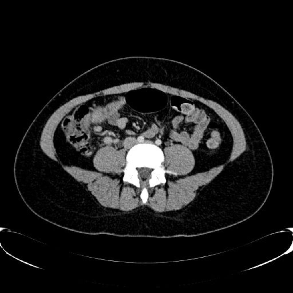 Fig. 1: CT axial plane: Enlarged lymph